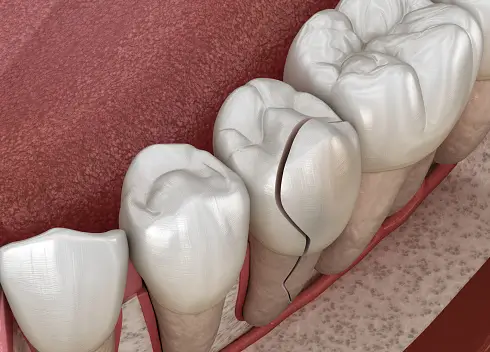 Trincas nos dentes
