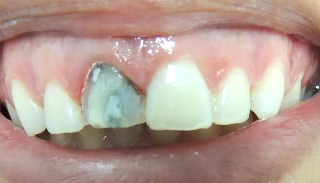 Dentes escurecendo com o tempo